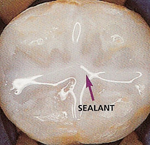 sealants 2