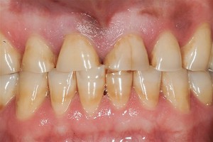 bruxism