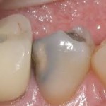 discolored teeth