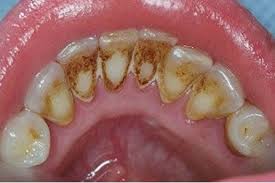 brownish discoloration of teeth