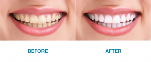 teeth-whitening-results