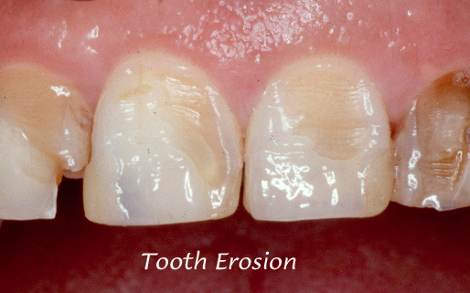 front tooth enamel loss