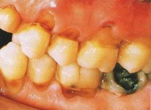Toothbrush-abrasion-along-cervival-margins-of-teeth-300x220