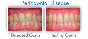 Gum-Disease-Pictures