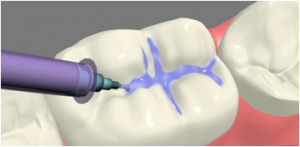 dental-fillings