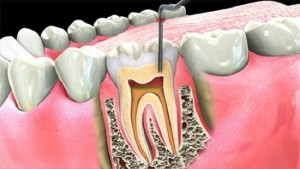 Root-canal-treatment