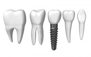 tooth implant