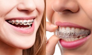 Braces-vs-Invisalign