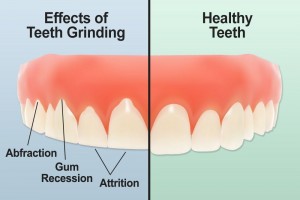 Teeth_Grinding