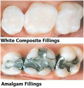 Amalgam-vs-Composite-Dental-Fillings