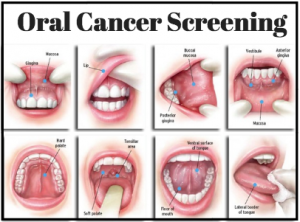 Oral-Cancer-Screening