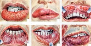 spot-oral-cancer