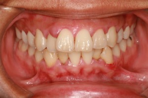 Is-Gingivitis-Contagious