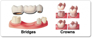 Dental-Crowns-and-Bridges