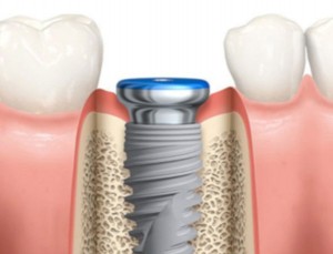 Parker-Family-Dental-Dental-Implants