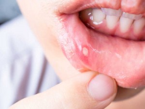 mouth ulcer 2