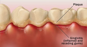 dental-plaque