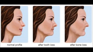 tooth loss