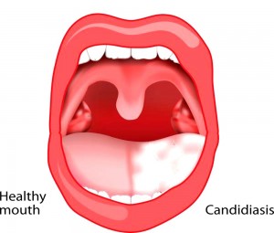 Oral candidiasis. oral thrush. healthy mouth and tongue with candidiasis infection