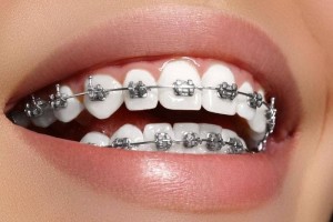 Metal-brace-to-align-and-straighten-crowded-teeth-min