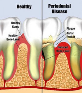 gum-disease-periodontial-disease