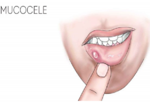 mucocele