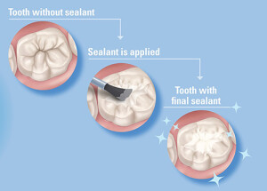 Sealants-3-image-500px