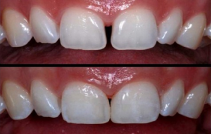 diastema-closure-500x500