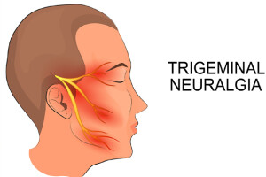 202003180308331587_Trigeminal-neuralgia-can-be-cured-medically-and_SECVPF