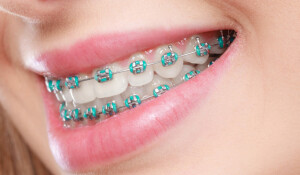 rubber-bands-for-braces-scaled-1170x684