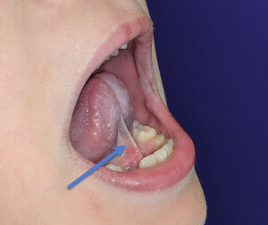 tongue-tie-ankyloglossia