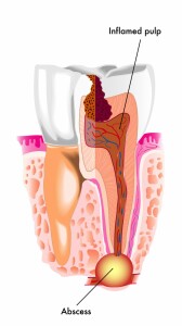 dental-abscess-long-island-suffolk-county