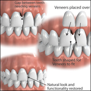 veneers_large