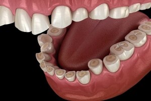 Tooth-erosion-min