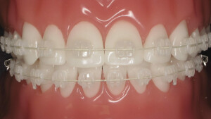 ceramic-braces-different-from-metal-1200x675