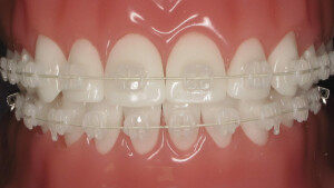 ceramic-braces-different-from-metal-1200x675