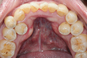 "Supernumerary premolar teeth may be defined as extra teeth occurring within thedental arch. It  can occur as singles, multiples, unilaterally or bilaterallyand in the maxilla, the mandible or both. Supernumerary premolar teeth in the mandible are rare.  Usually the teeth are unerupted and may have no effect on the developing dentition.However, in some cases they may lead to impaction, cyst development and root resorption of the adjacent permanent teeth."