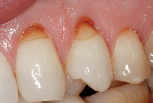 Tooth-Abrasion