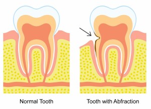 abfraction