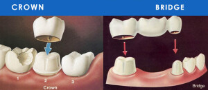 pVgdental-crowns-bridges.x43969