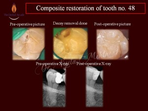 Mr. G. S. Sangha composite restoration